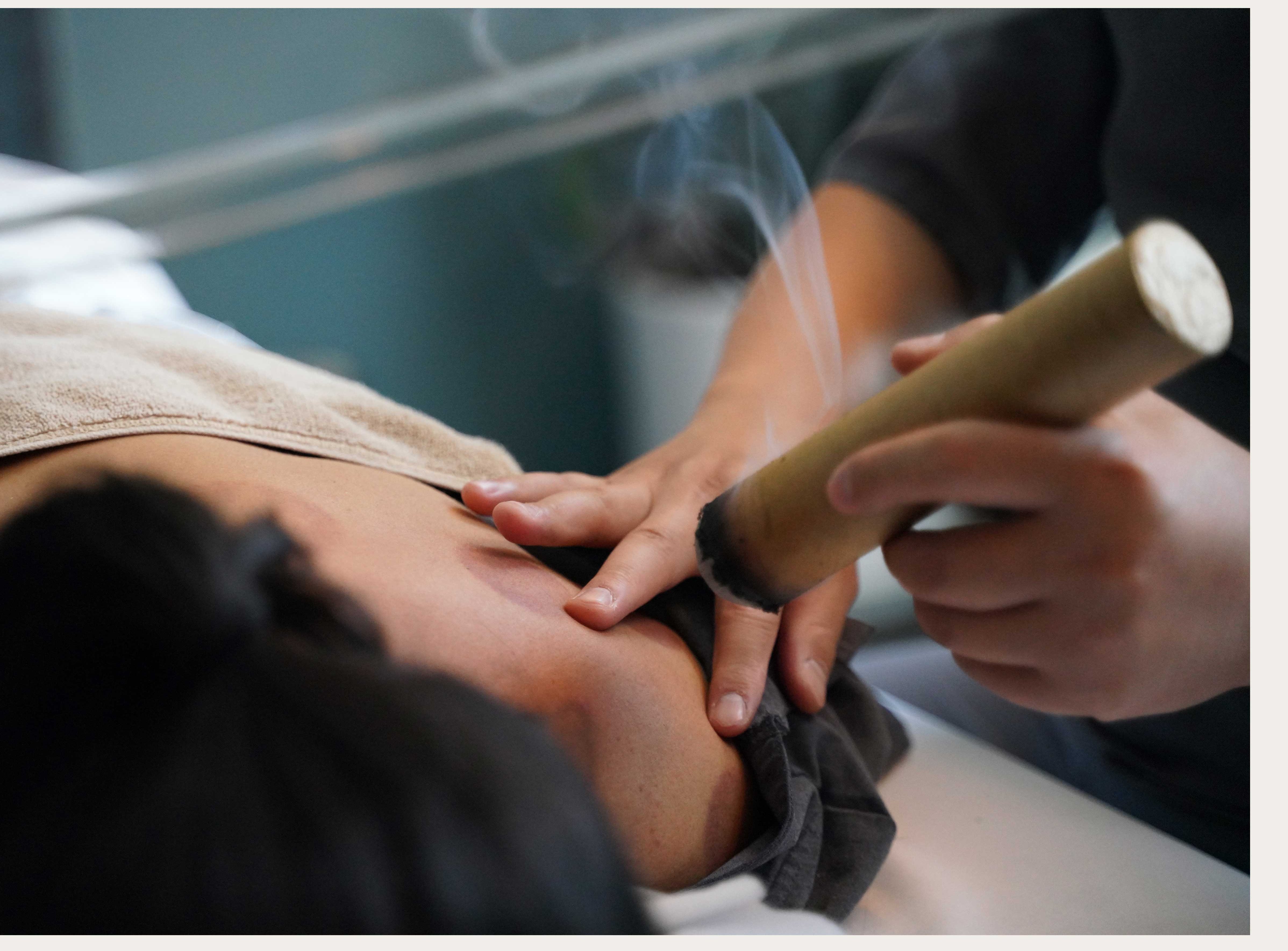 Moxibustion therapy at Serensia Woods
